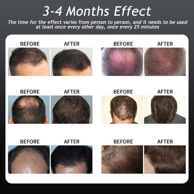 288 Medical-Grade Mobile Laser Therapy Cap for Hair Regrowth For Men and Women